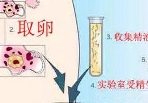 试管婴儿移植后出现烧心症状正常吗？