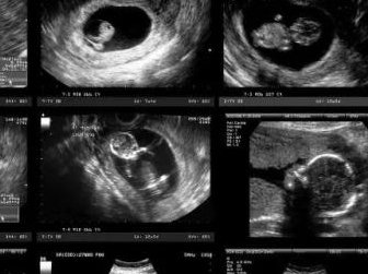 45岁女性长沙中信湘雅做试管婴儿的成功率高吗？是多少？